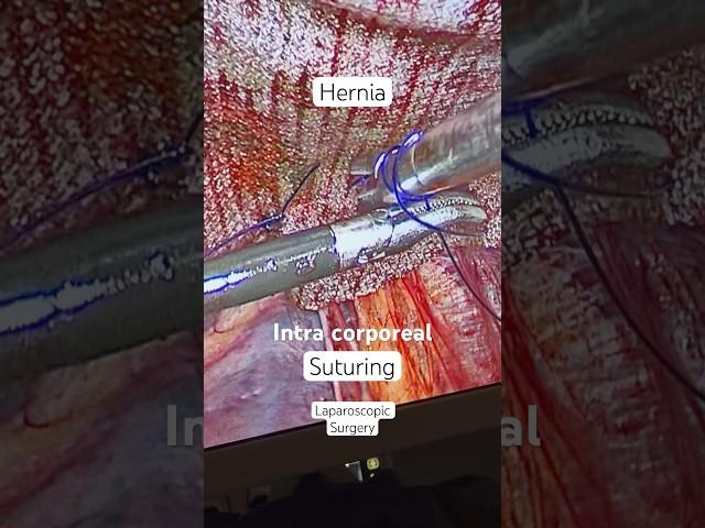 Intra corporeal Suturing I Laparoscopic Suture Fixation of Hernia Mesh I Umbilical Ventral Hernia