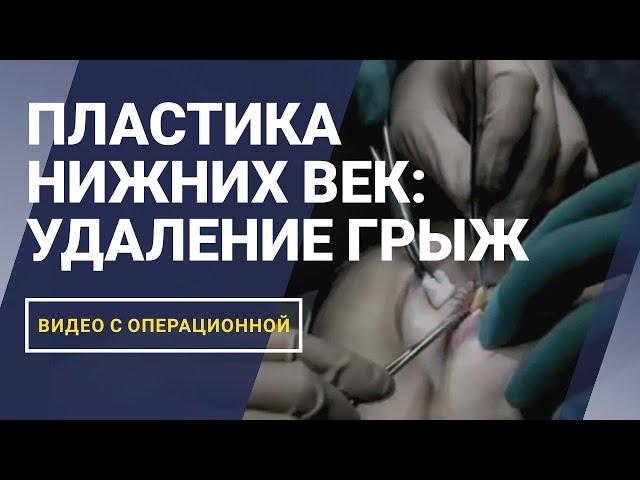 ПЛАСТИКА НИЖНИХ ВЕК: УДАЛЕНИЕ ГРЫЖ | Трансконъюктивальная блефаропластика | ВИДЕО С ОПЕРАЦИОННОЙ