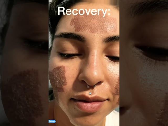 We Treated Her Acne in just One Day! #skincare #beauty #shorts #laser