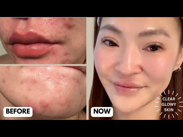 How I Cleared My Adult Hormonal Acne Breakouts (for good) | Cystic Acne (2024)
