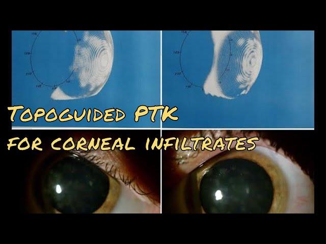 Corneal LASER Surgery: Transepi Topography-guided PTK for treatment of adenovirus nummular keratitis