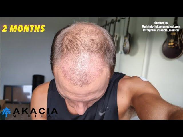 Hair Transplant Growth Timeline - the first 3 months!