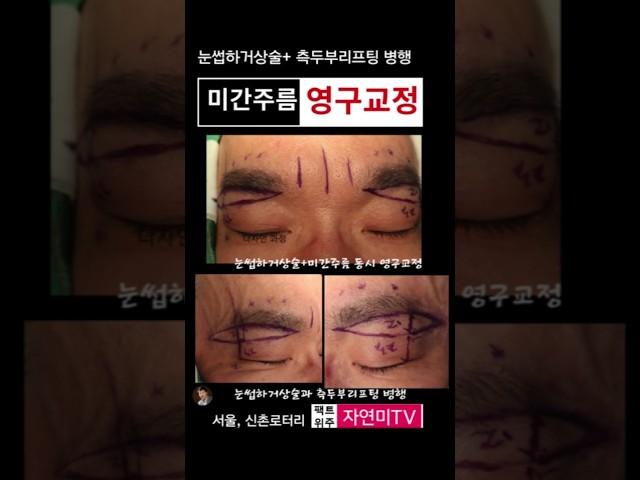 눈썹하거상술과 미간주름 동시교정 가능할까? #신촌성형외과 #마포성형외과 #미간필러부작용 #미간필러실명 #미간필러피부괴사 #상안검성형 # 윗눈거풀 처짐 #은평성형외과 #마포성형외과
