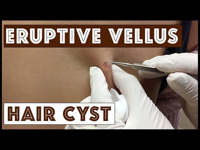 Unusual types of Cysts: Eruptive Vellus Hair Cysts, Part 1 in a Series