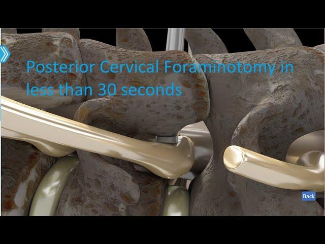 Posterior Cervical Foraminotomy 30 seconds