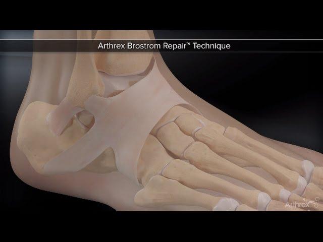 Arthrex Brostrom Repair™