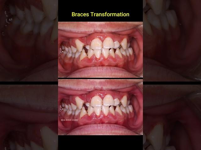 Braces 24 months - Crooked teetg #braces #dentist #orthodontist #dental