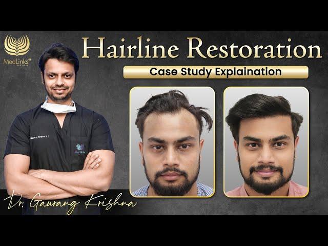 Transformative Hairline Restoration Case Study Hair Transplant Before After Results | Medlinks