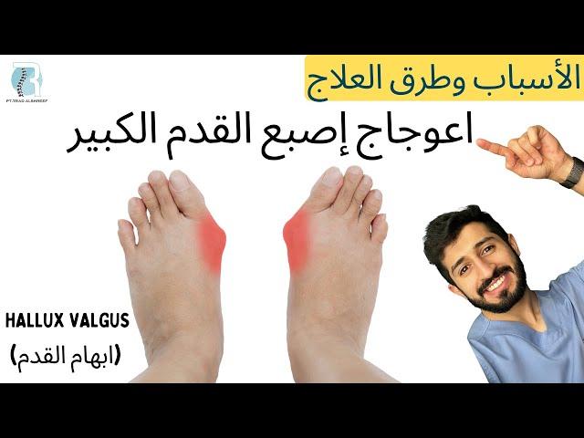 انحراف إصبع القدم الكبير الاسباب وطرق العلاج 3 تمارين - الوكعة - إبهام القدم الأروح - Hallux Valgus