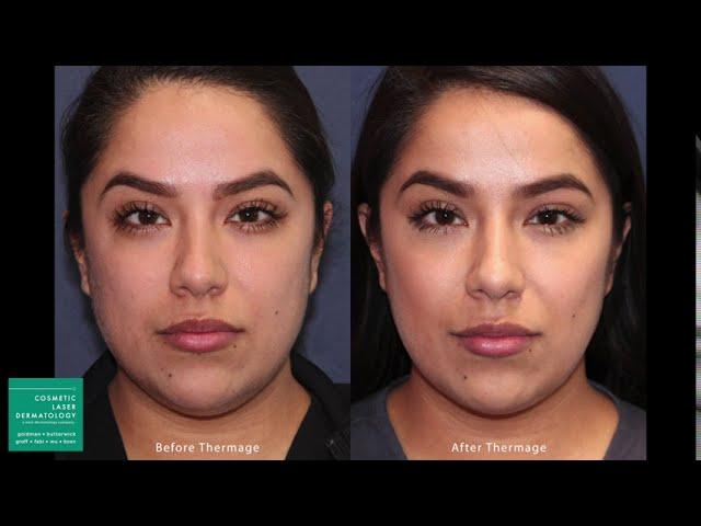 Thermage Skin Tightening Treatment by Leysin Fletcher, PA-C | Cosmetic Laser Dermatology San Diego