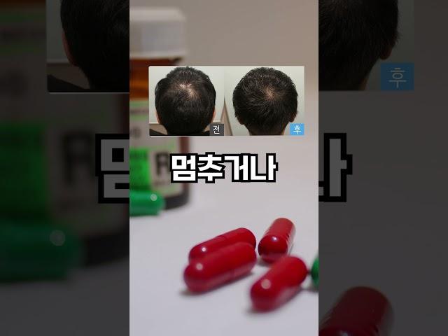참닥터에서 모발이식 후 탈모치료로 두마리 토끼를 잡으세요!
