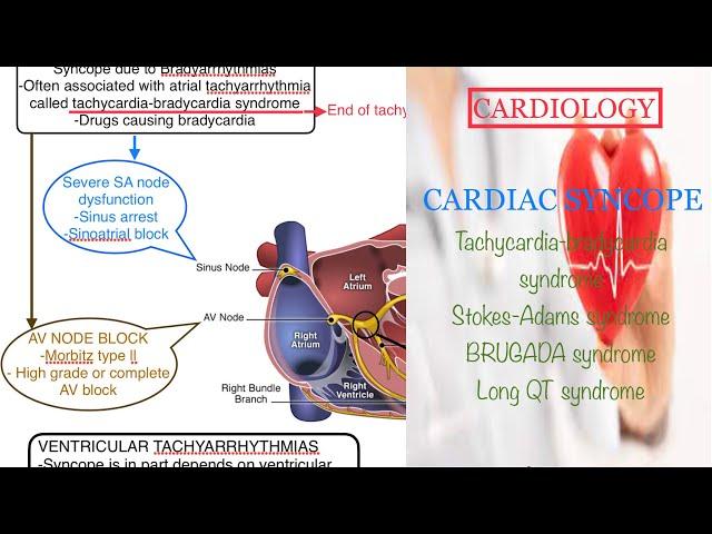 CARDIAC SYNCOPE @Tachycardia bradycardia syndrome@ Stokes adams syndrome@brugada stndrome@long QT sy