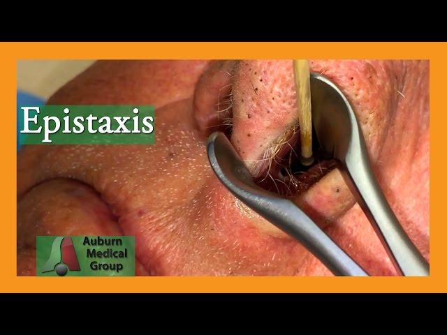 Epistaxis | Auburn Medical Group