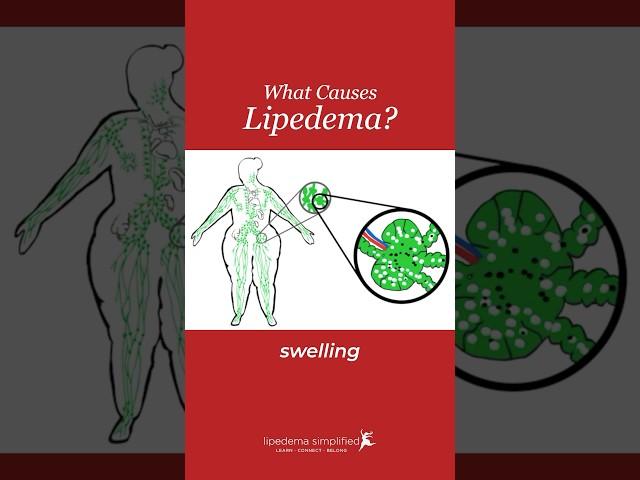 What really causes lipedema, lymphedema, and lipolymphedema?