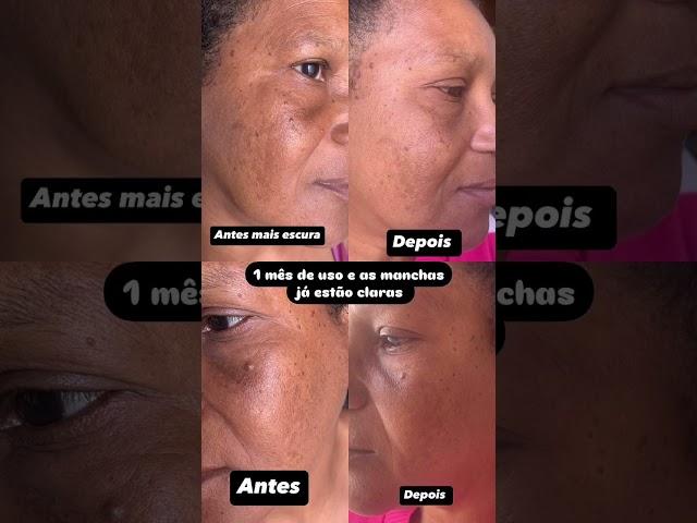 O que é bom tem que ser divulgado mesmo. O antes e depois das manchas de acne é meu próprio rosto.