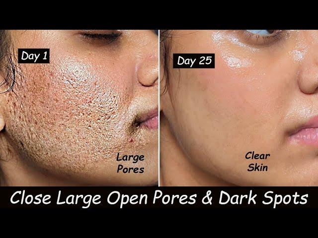 Close Large Open Pores, Dark Spots & Skin Whitening - Potato Face Pack & Potato ice cubes