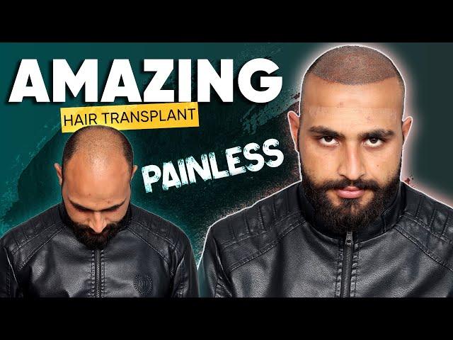 Hair Transplant in Lucknow | Best Results & Cost of Hair Transplant in Lucknow