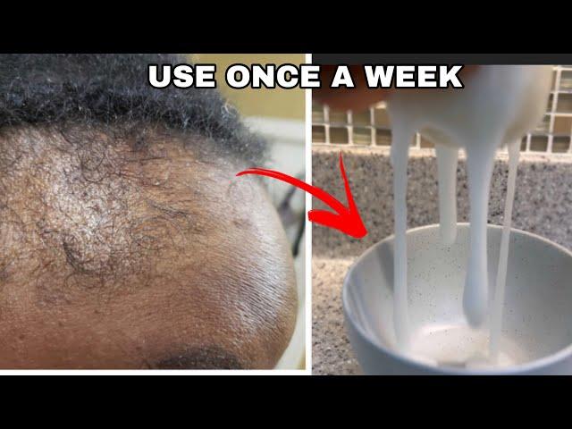 NO JOKE! THIS HAIR GROWTH RECIPE WILL SAVE LIVES! USE ONLY ONCE A WEEK! May 19, 2024