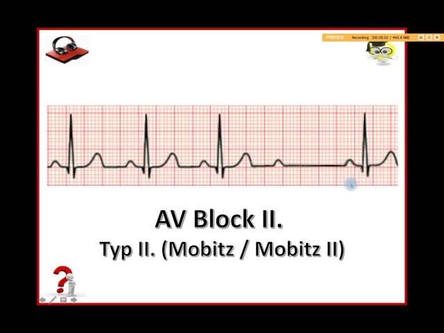 Ekg Podcast 25 of 59. AV Blokády. 3. Časť