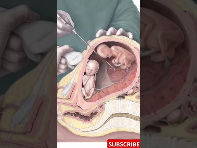 Amniocentesis Explained: The Procedure, Risks & Benefits