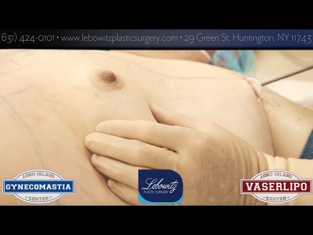 Immediate Hi Def Vaser Lipo Results At The Vaser Center Long Island NY by Dr.Lebowitz