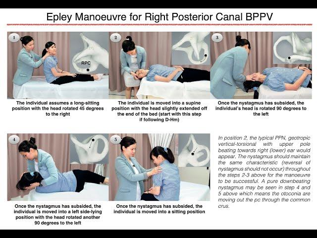 Epley Manoeuvre for Right Posterior Canal BPPV