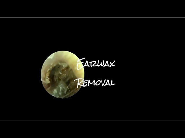 Earwax extracted #earwaxremoval #foryou #earwax #fypyoutube #satisfying #asmr