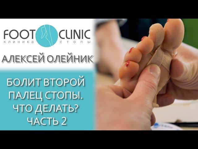 Молоткообразная деформация  2-го пальца. Часть 2.