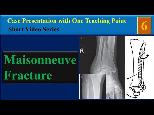 Maisonneuve Fracture ,Case Presentation with One Teaching Point