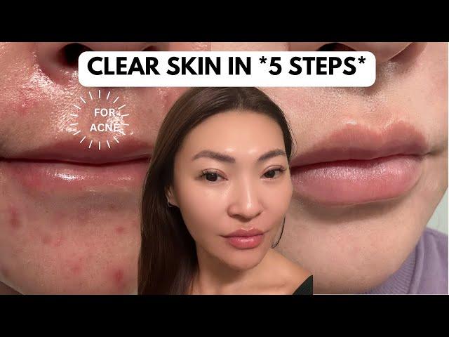 5 Step Acne Skincare Routine (AM & PM) | How I Got Rid of Acne, Scars, Texture (2024)