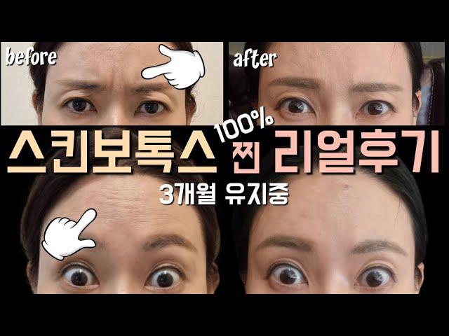 스킨보톡스 찐 100% 리얼후기‼️(ft. 통증, 부작용, 지속기간, 가격, 효과, 내성) 완벽정리