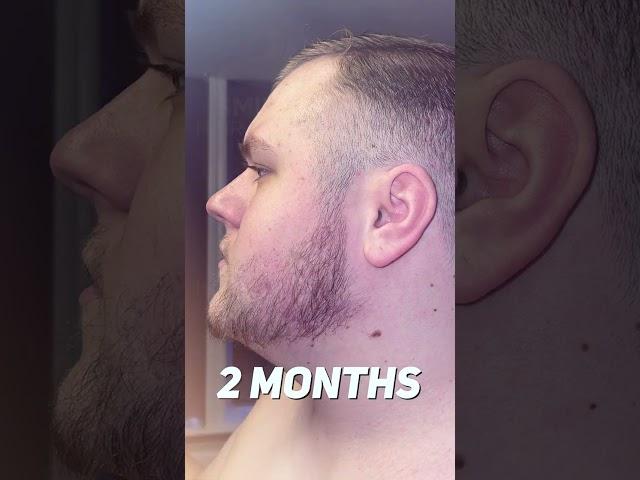 BEARD TRANSPLANT BEFORE AND AFTER - SMILE HAIR CLINIC - 4600 GRAFTS #beardtransplant