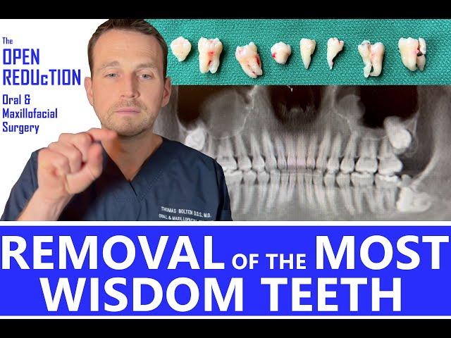 8 WISDOM TEETH REMOVED on 1 PATIENT