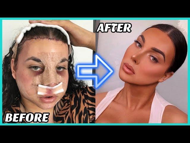 My Plastic Surgery Experience in Korea! (Facial Feminisation Surgery)  |  PART 2