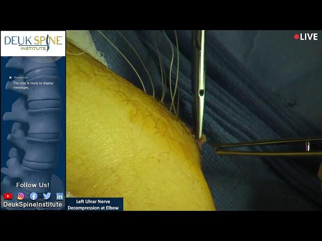 Watch Live Surgery! Left Ulnar Nerve Decompression at Elbow