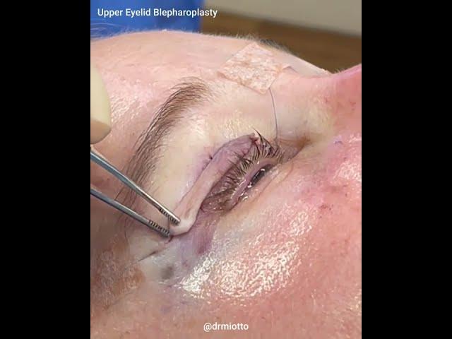 Skin only upper blepharoplasty (upper eyelid surgery) | Atlanta Plastic Surgeon