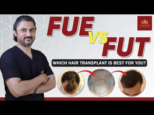 FUE vs FUT Hair Transplant Which is Better For You | FUE vs FUT Results and Cost | Crown