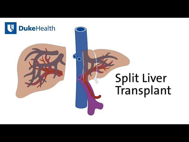 Split Liver Transplant Saves Two Lives with One Organ | Duke Health