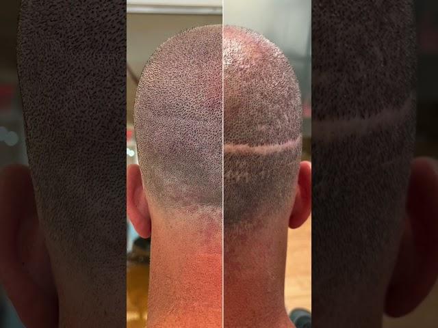 Hair transplant scar camouflage  #scalpmicropigmentation #hairtattoo #scar #scarstreatment