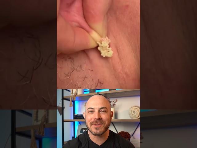 Derm reacts to HUGE ear cyst! #cystpop #dermreacts #doctorreacts