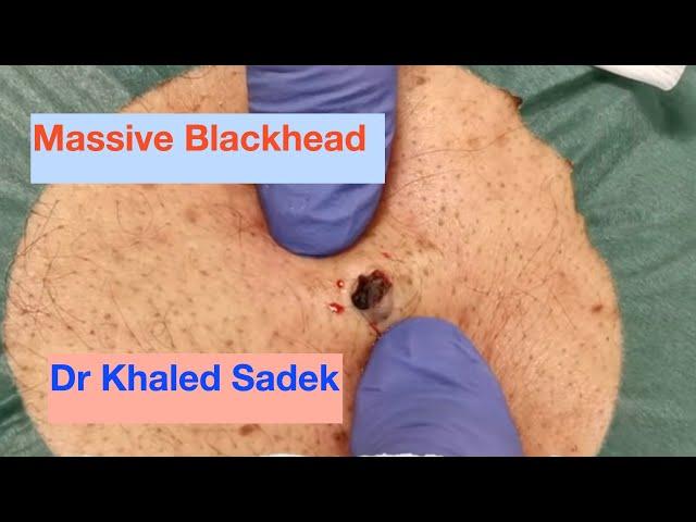 Large Blackhead removal. Dr Khaled Sadek. LipomaCyst.com