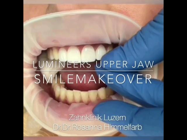 Lumineers & Veneers Zahnklinik Luzern Dr.Dr.Rosanna Himmelfarb