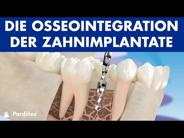 Die Osseointegration der Zahnimplantate ©