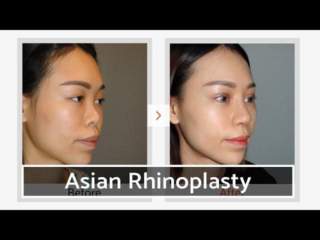 Asian Rib Cartilage Rhinoplasty | VIP Plastic Surgery Center, Seoul, Korea