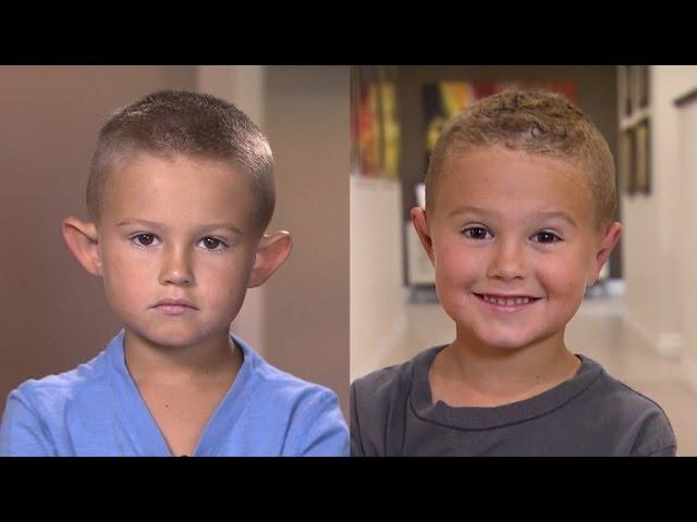 Parents Allow 6-Year-Old Boy with Big Ears to Get Plastic Surgery