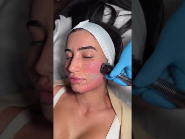 Forma Skin Tightening Procedure | Avance Plastic Surgery: Dr. Erez Dayan | Reno, Tahoe, NV