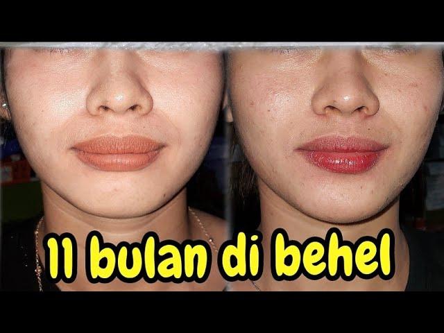 11 bulan perawatan behel gigi tonggos, bibir tebal atas, dokter gigi Jogja menjelaskan