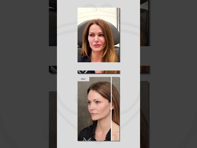 Amazing AuraLyft #facialplasticsurgery #drbentalei