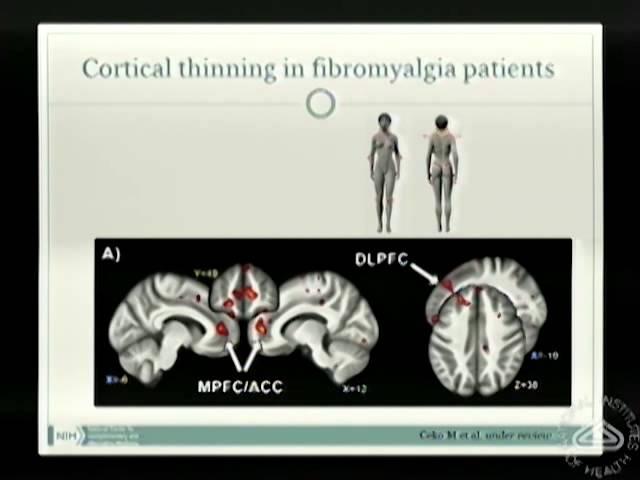 Brain Changes in Chronic Pain Patients