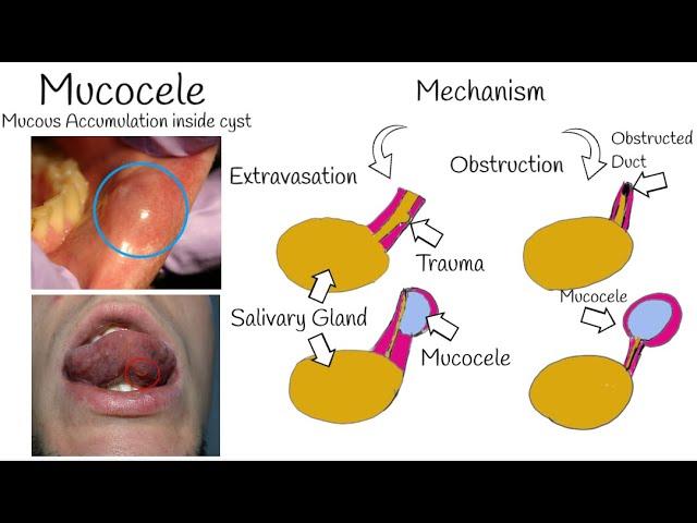 Oral Mucocele -  The Most Common Mucosal lesion - Mucous Cyst: Symptoms, Causes & Treatment